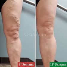 CAPSULAS ANTIVARISES+ACEITE AYURVEDICO P